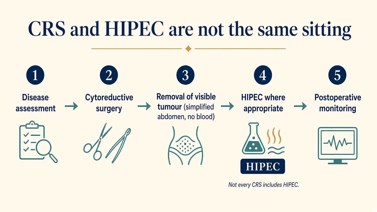 Illustration showing the main stages of cytoreductive surgery and HIPEC treatment