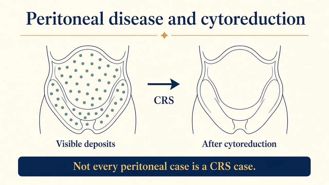 Medical illustration showing peritoneal tumour deposits and the concept of cytoreductive surgery