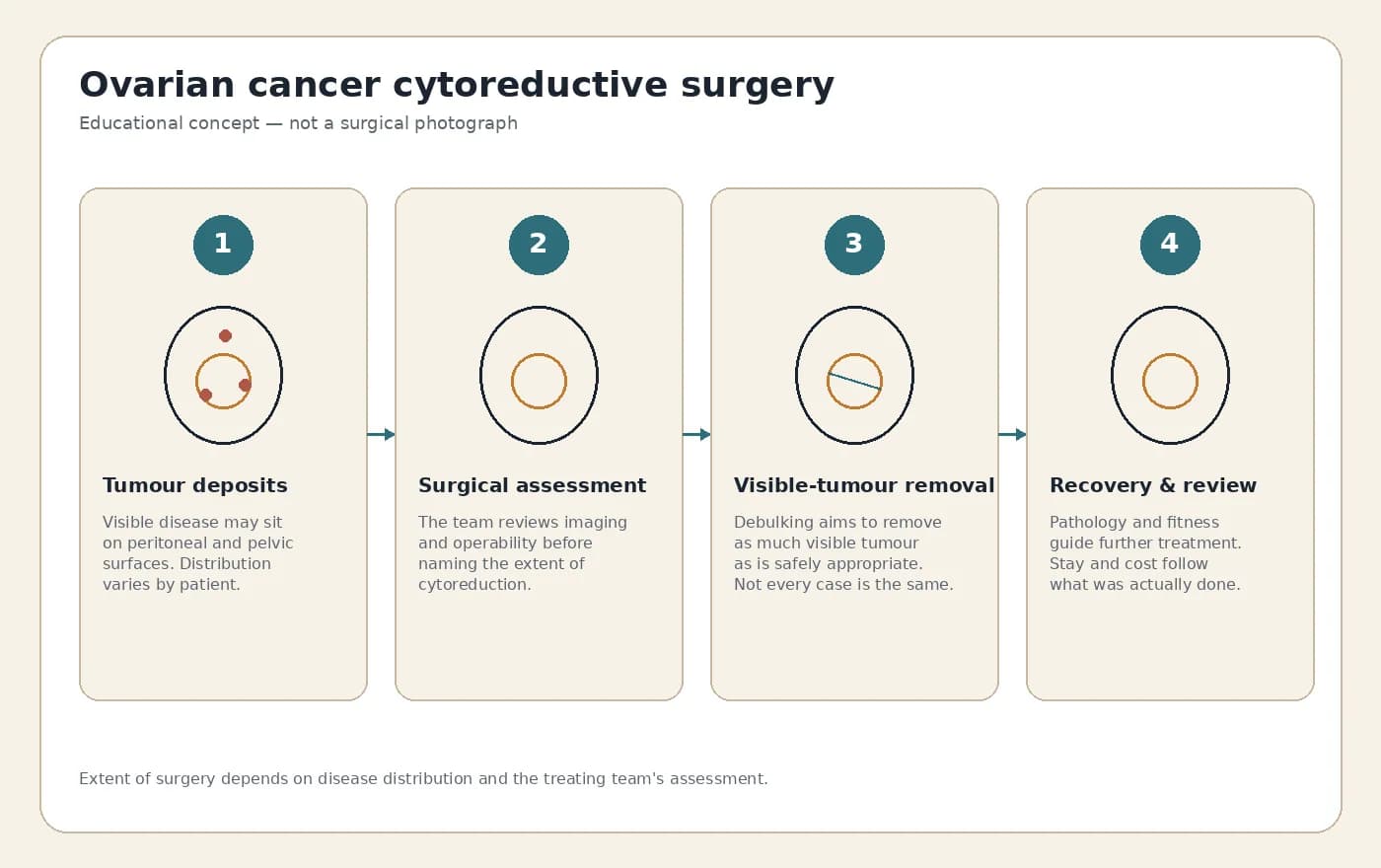 Medical illustration explaining ovarian cancer cytoreductive surgery and tumour debulking