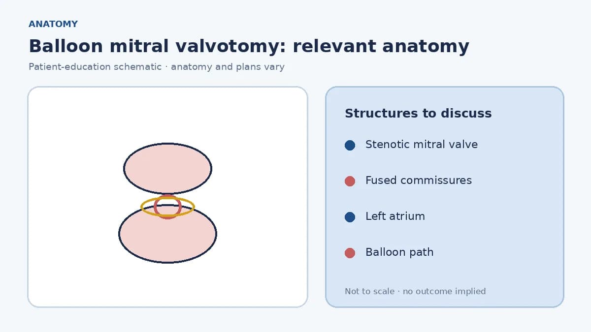 Medical illustration of a stenotic mitral valve with fused commissures limiting left-ventricular filling