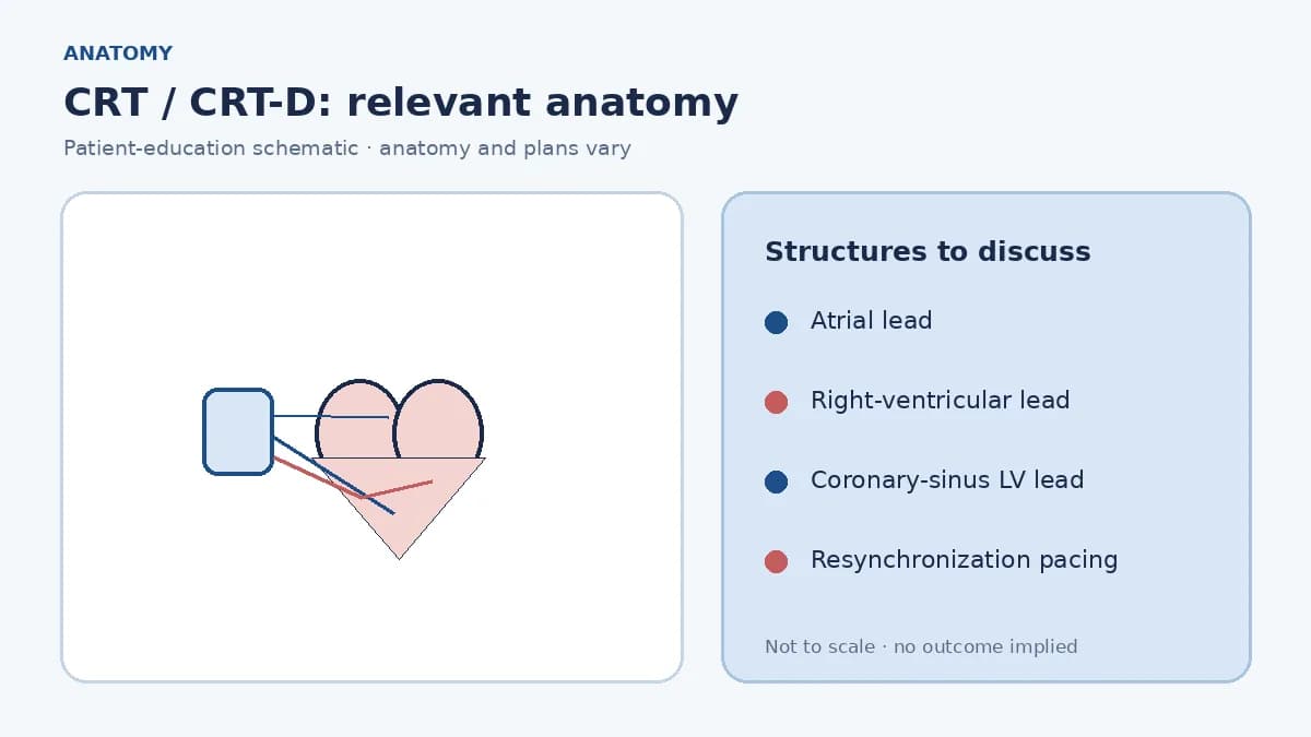 Medical illustration of delayed left-ventricular activation in a dilated heart relevant to cardiac resynchronization