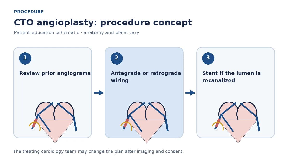 Clinical diagram of dual arterial access and specialized wires attempting to recanalize a chronic total occlusion