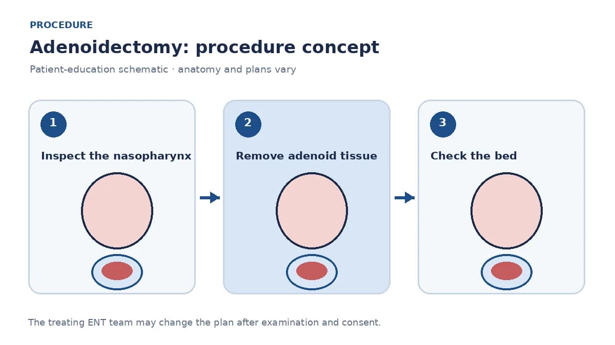 Clinical diagram of adenoid removal from the nasopharynx under oral view