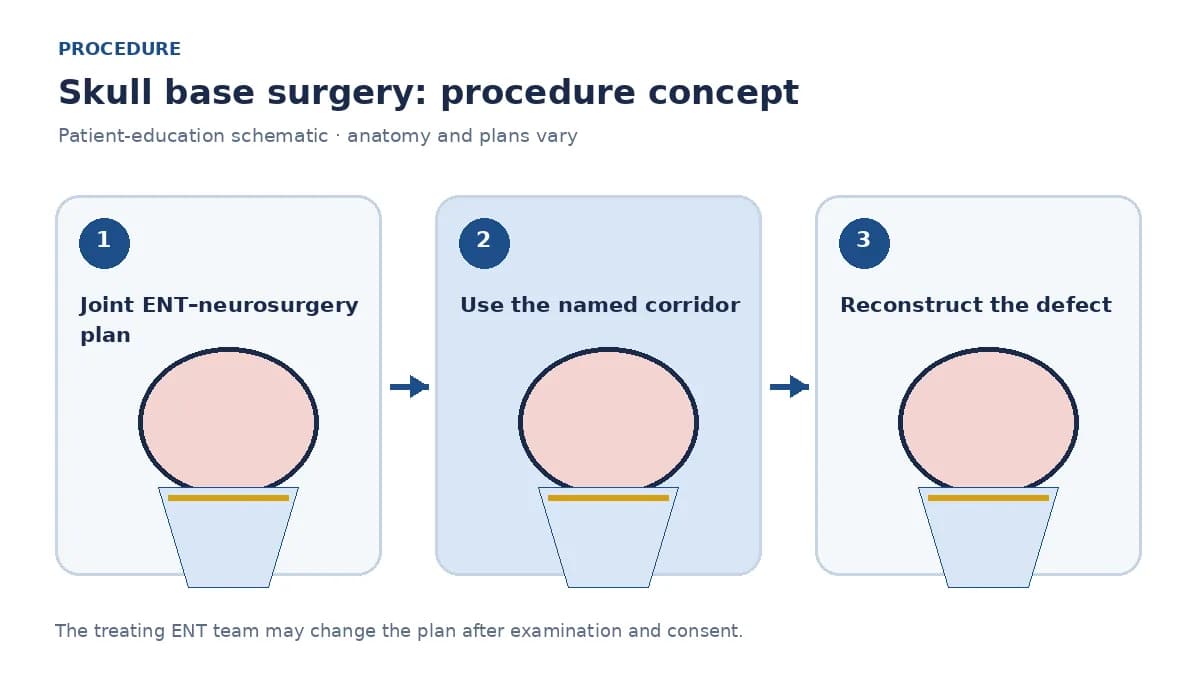 Clinical diagram of an endoscopic endonasal approach to a midline skull-base lesion with planned reconstruction