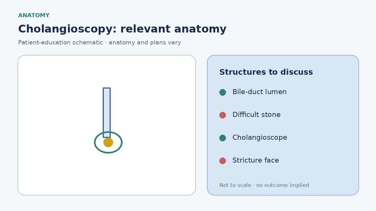Medical illustration of a cholangioscope inside the bile duct looking at a stone or stricture