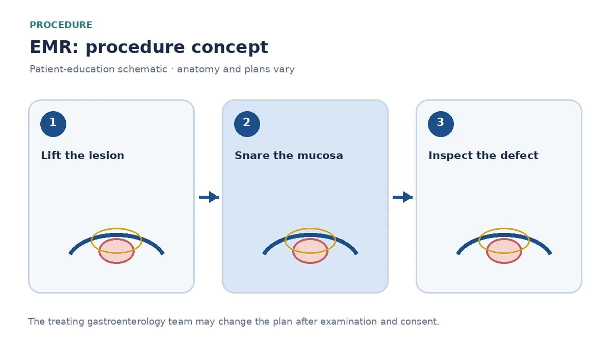 Clinical diagram of fluid lift and snare removal of a mucosal lesion during EMR