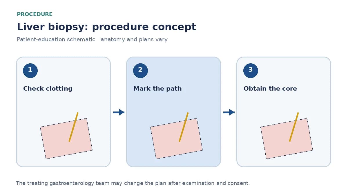 Clinical diagram of an ultrasound-guided needle obtaining a liver core