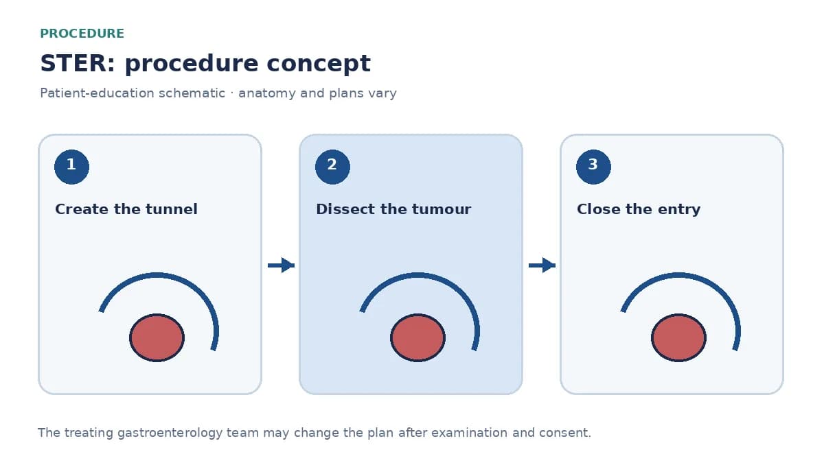 Clinical diagram of a submucosal tunnel used to dissect and extract the lesion during STER