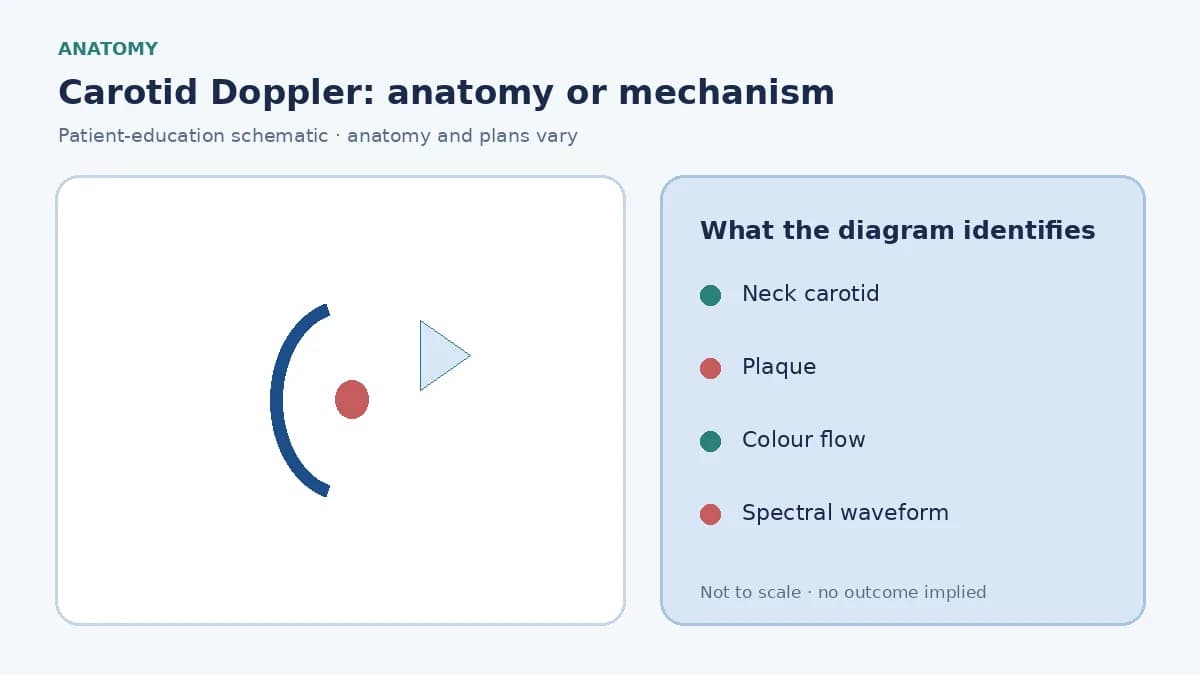 Patient-education diagram showing an extracranial neck carotid artery plaque assessed by colour and spectral duplex