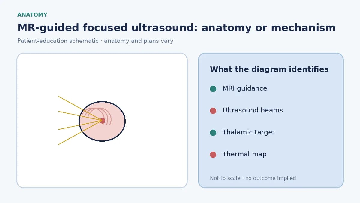 Patient-education diagram showing MRI-guided converging ultrasound beams focused on a selected thalamic tremor target