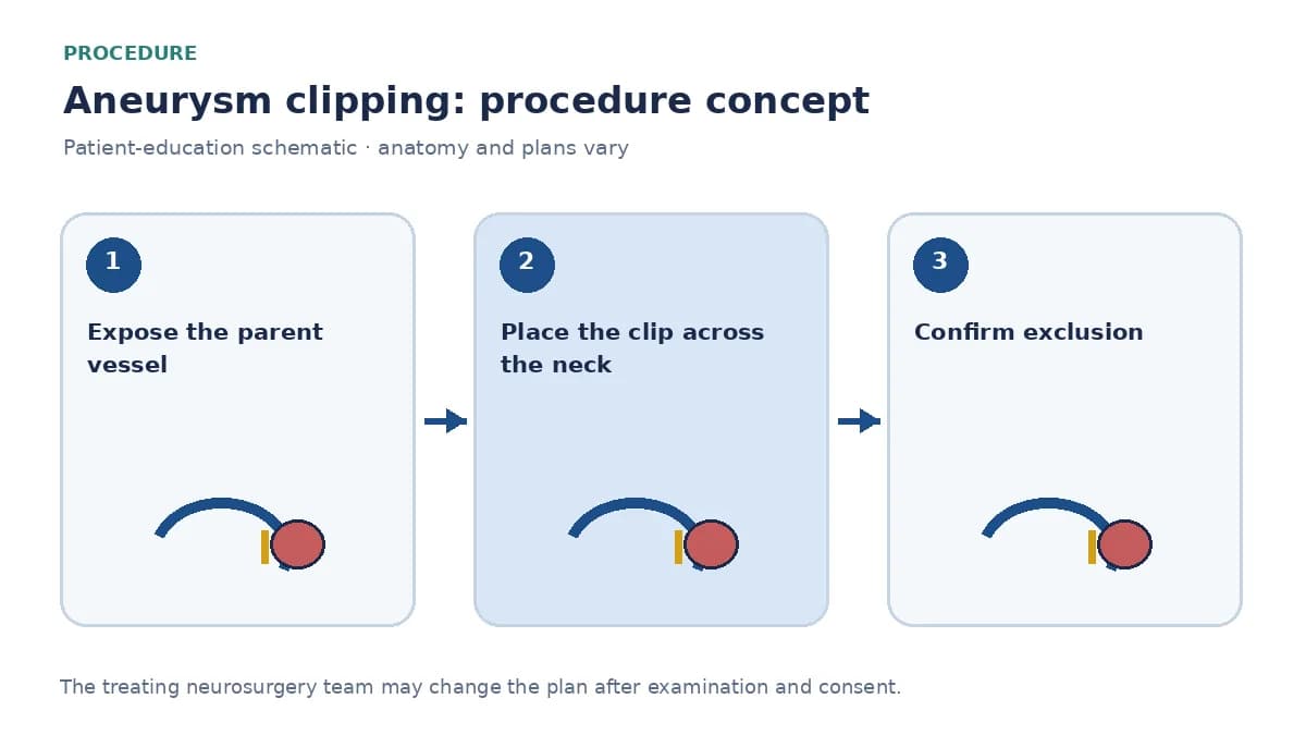 Clinical diagram of microsurgical clip placement across an aneurysm neck after craniotomy