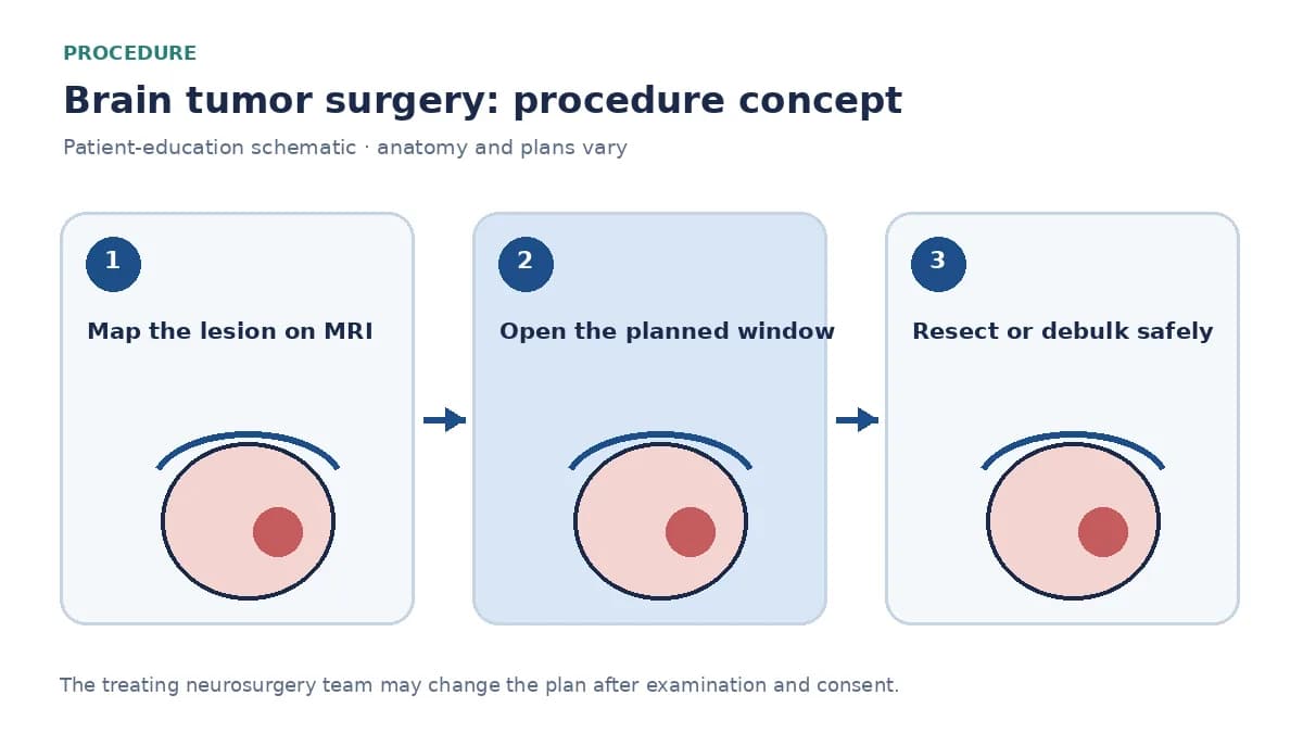 Clinical diagram of craniotomy, tumour resection and neuronavigation used in brain tumor surgery