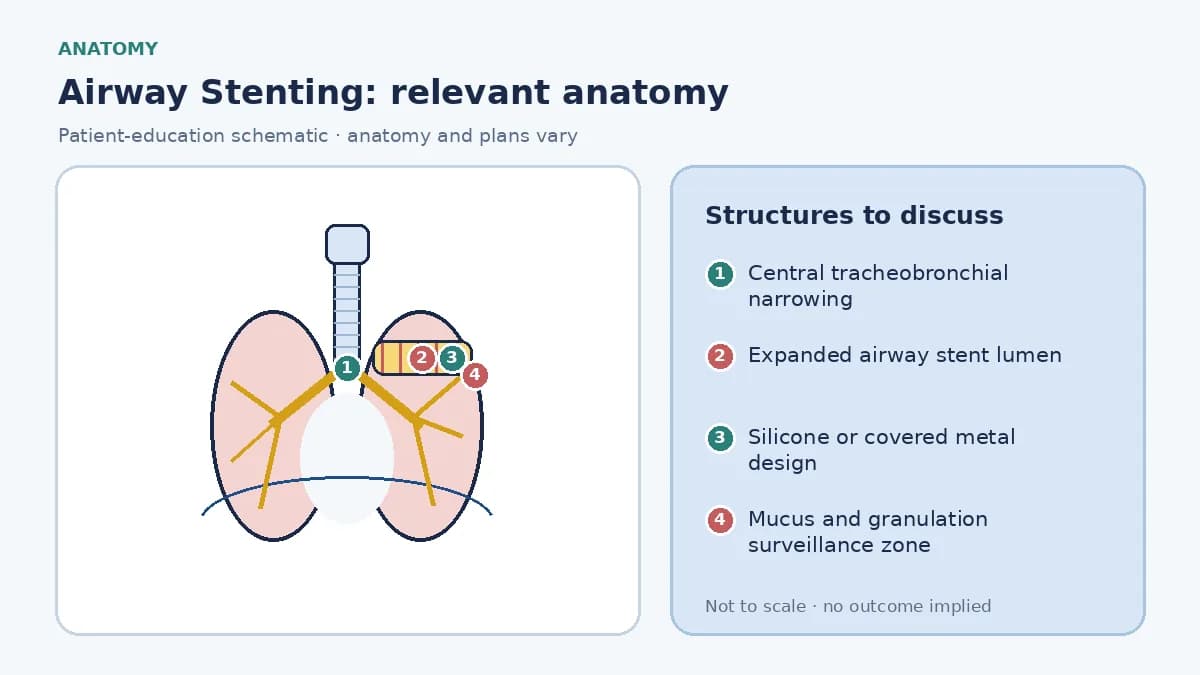 Educational central-airway diagram showing a narrowed main bronchus held open by an expanded labelled stent, with silicone and covered-metal design cues and surveillance zones for mucus and granulation