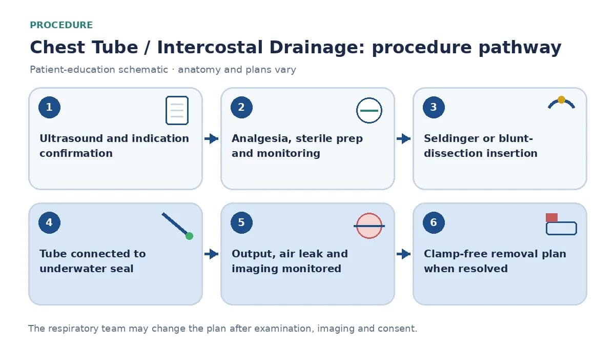 Chest-drain pathway showing ultrasound and indication confirmation, analgesia and sterile preparation, Seldinger or blunt-dissection insertion, seal connection, output and air-leak monitoring and removal planning