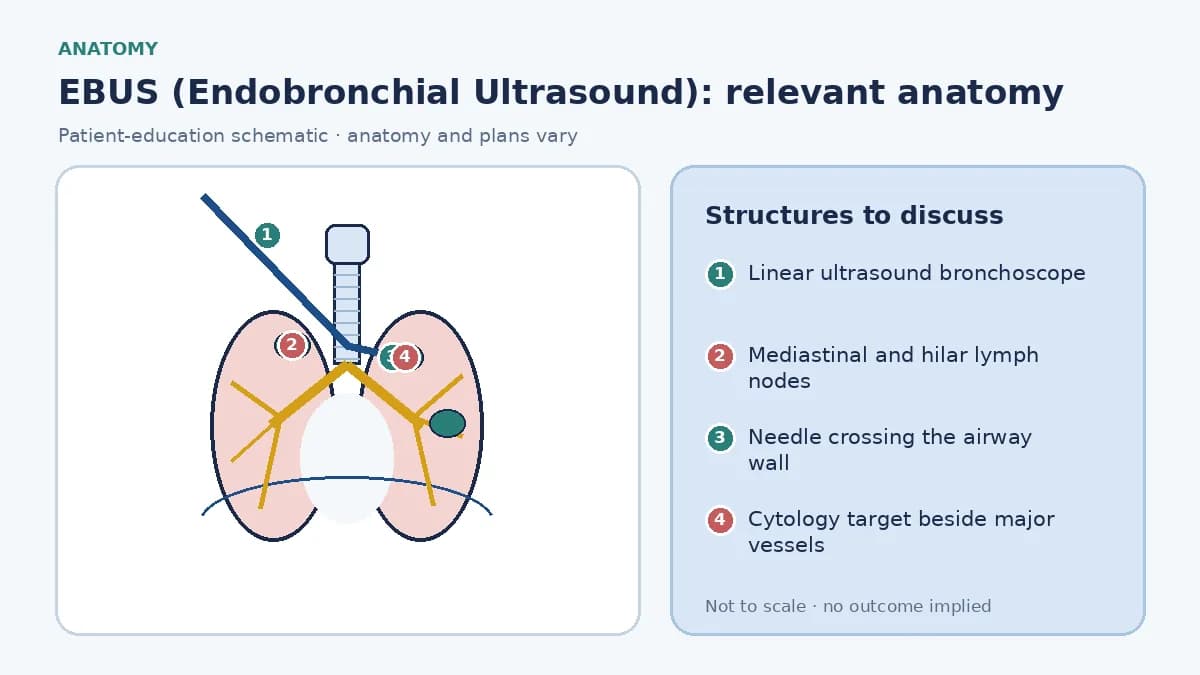 Educational chest schematic showing a linear EBUS bronchoscope in the tracheobronchial tree, labelled mediastinal and hilar nodes, Doppler-checked vessels and a needle crossing the airway wall into a node