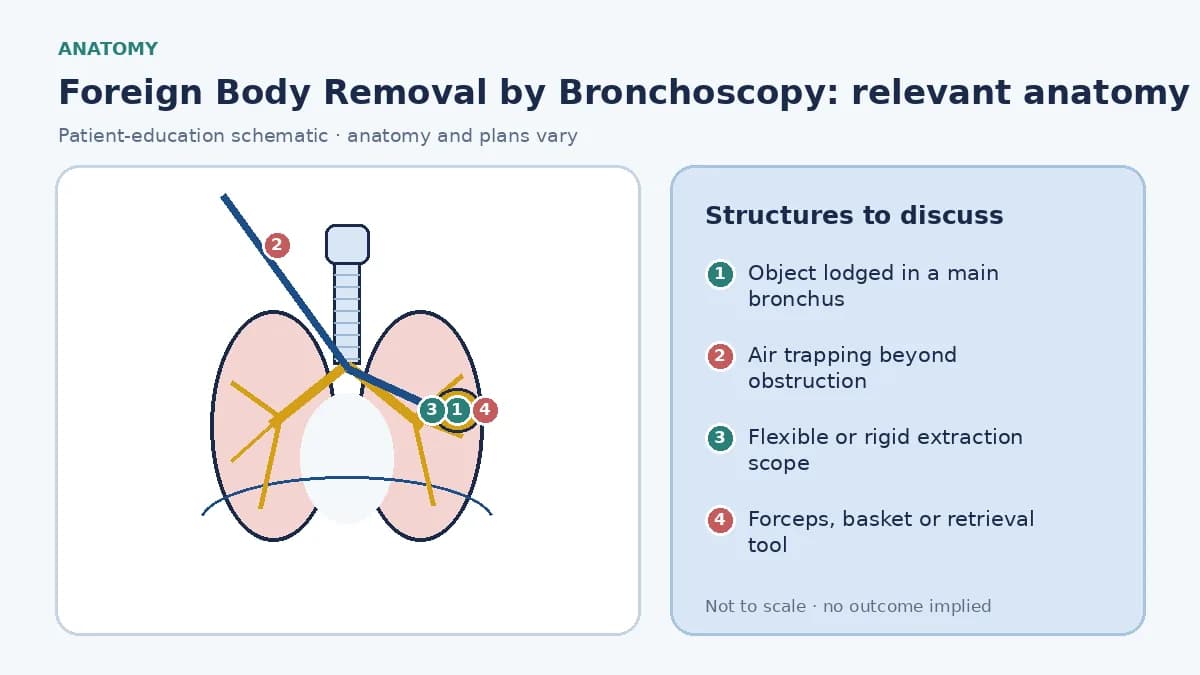 Educational airway diagram showing an aspirated object lodged in a main bronchus, distal air trapping, flexible and rigid scope routes and a retrieval forceps or basket securing the object