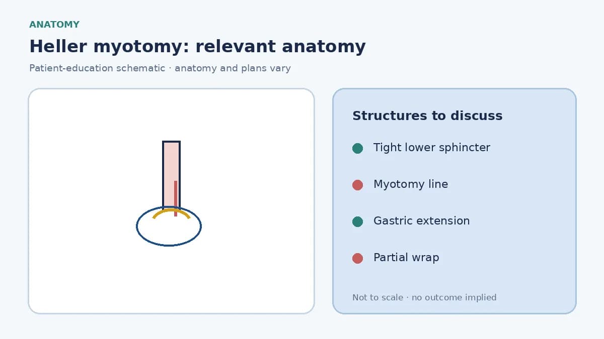 Medical illustration of a tight lower-oesophageal sphincter in achalasia with the planned Heller myotomy line