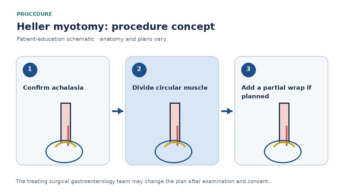 Clinical diagram of laparoscopic Heller myotomy dividing circular muscle and adding a partial fundoplication