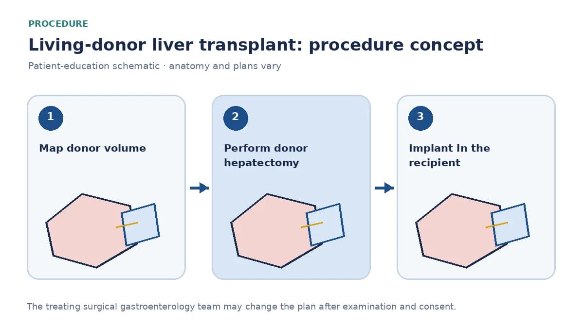 Clinical diagram of simultaneous donor hepatectomy and recipient implantation in living donor liver transplantation