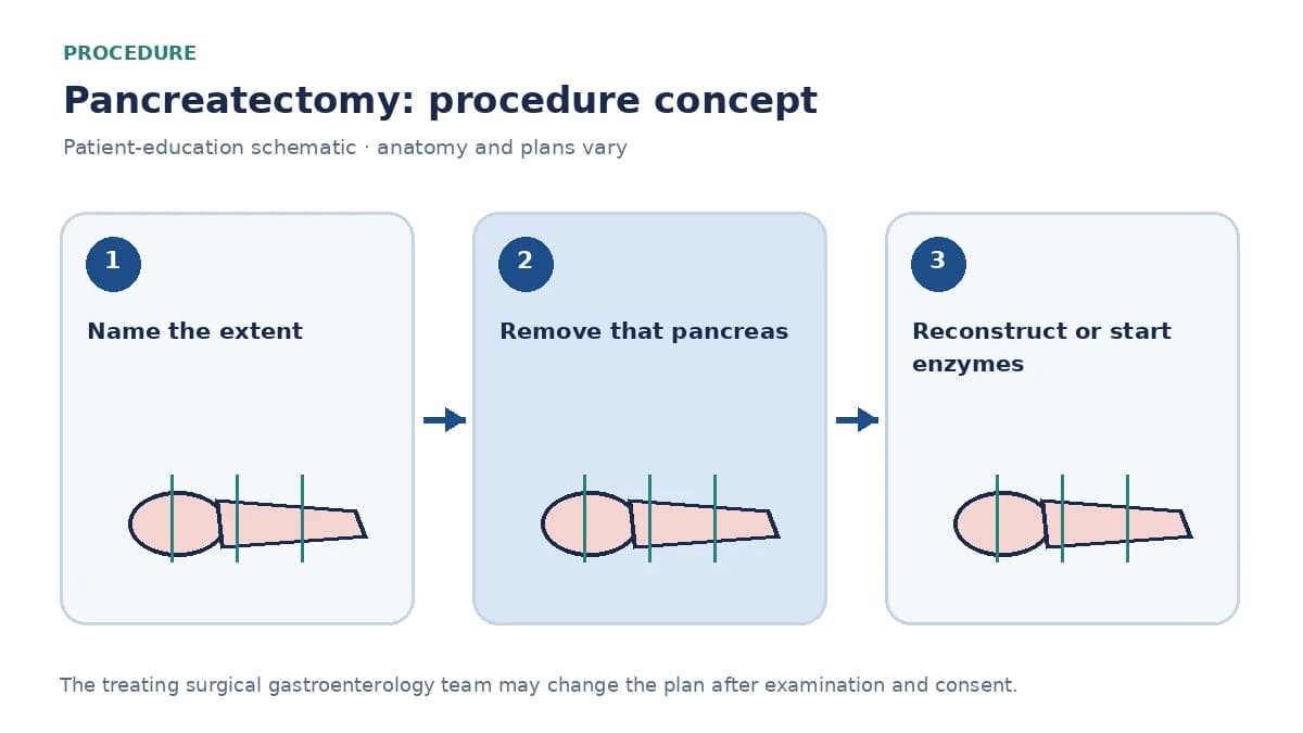 Clinical diagram comparing central, extended and total pancreatectomy concepts