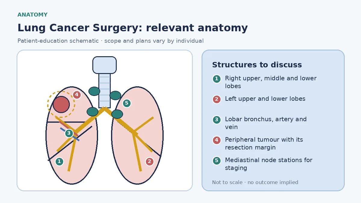 Medical illustration of lung anatomy for cancer surgery: three right and two left lobes with their bronchus, artery and vein, a peripheral tumour in one lobe, and the mediastinal node stations sampled for staging.