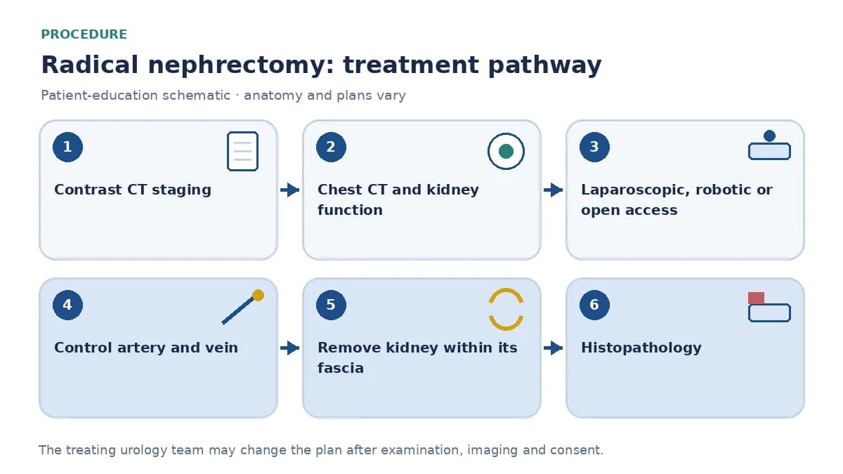 Step-by-step radical nephrectomy pathway infographic showing contrast CT staging, chest CT, kidney-function assessment, laparoscopic or open vessel control, removal of the kidney within its fascia and histopathology