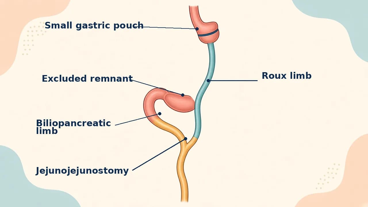 Medical illustration of a small gastric pouch connected to a Roux small-bowel limb with a downstream jejunojejunal connection