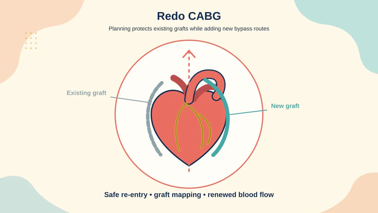 Medical illustration of repeat sternotomy adhesions, patent bypass graft protection and placement of new coronary grafts