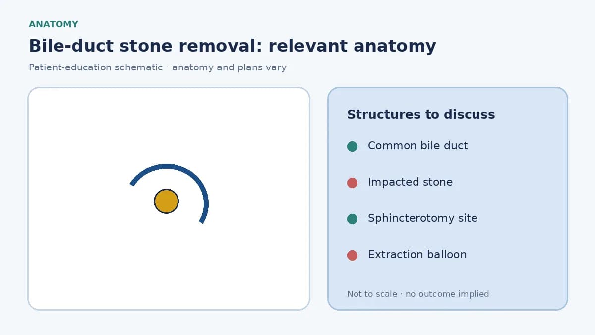 Medical illustration of gallstones in the common bile duct below the liver and gallbladder