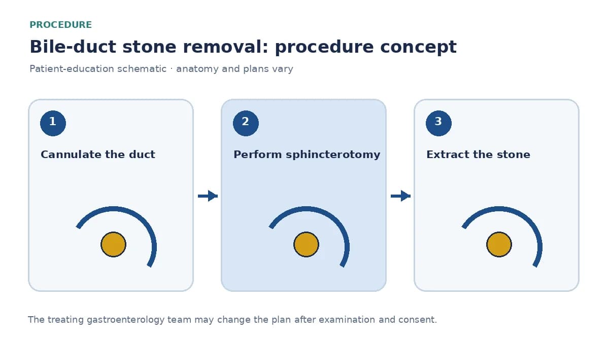 Clinical diagram of balloon extraction of a bile-duct stone after sphincterotomy
