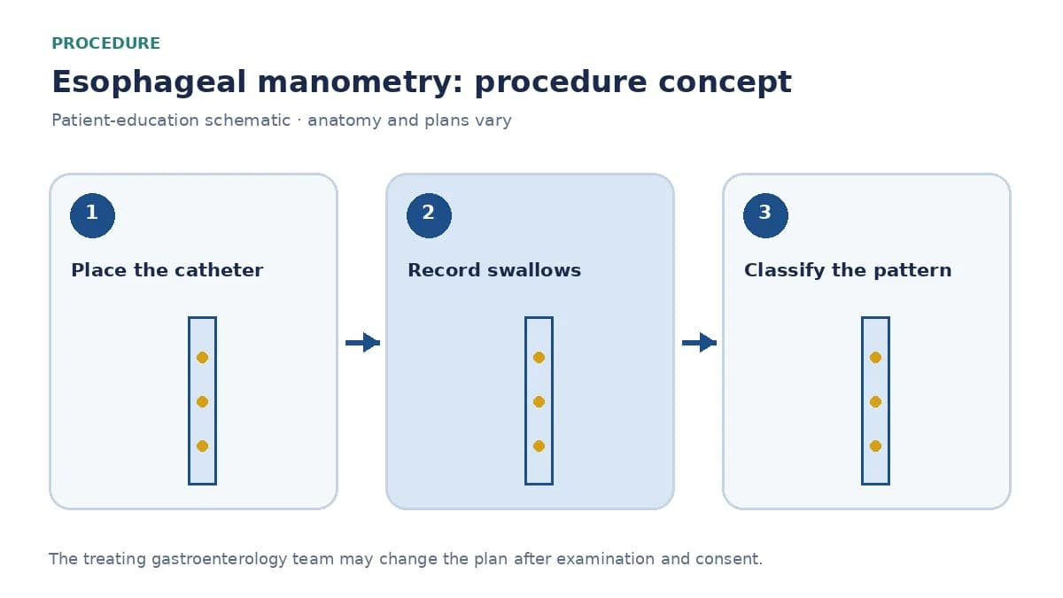 Clinical diagram of a nasal manometry catheter sensing swallow pressures