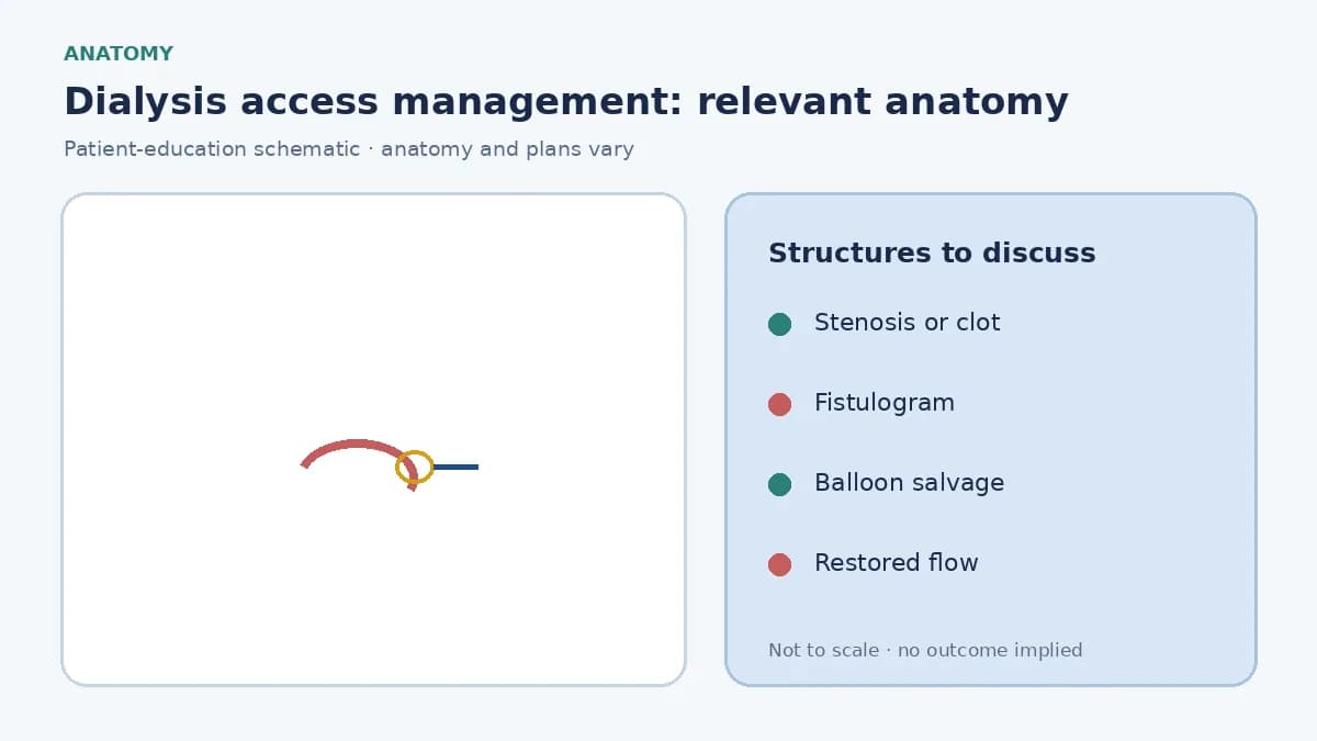 Medical infographic of a stenosed hemodialysis fistula with a balloon angioplasty concept for restoring flow
