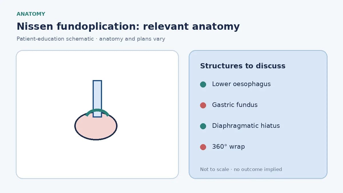 Medical illustration of the gastro-oesophageal junction, fundus and hiatus involved in Nissen fundoplication