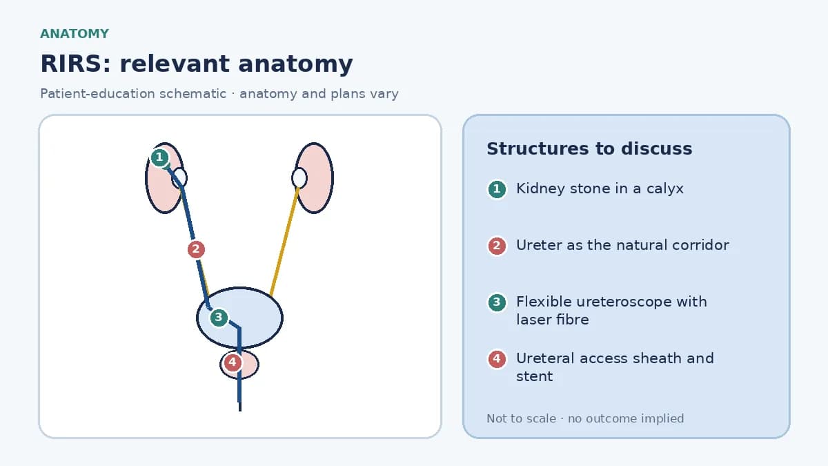 Medical infographic of RIRS anatomy showing the urethra, bladder, ureter and kidney with a flexible ureteroscope passed retrograde into a calyx holding a stone and a laser fibre at its tip