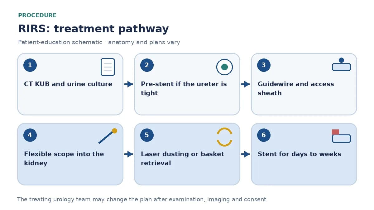 Step-by-step RIRS pathway infographic showing CT stone assessment, urine culture, guidewire and access-sheath placement, flexible ureteroscopy with laser dusting or fragmentation, basket retrieval and stent placement